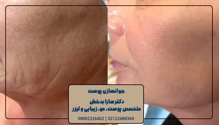 جوان سازی پوست