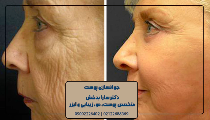 جوانسازی صورت