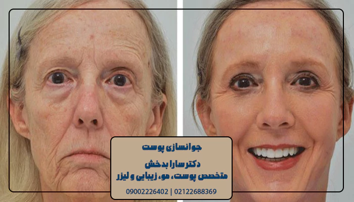جوانسازی پوست صورت