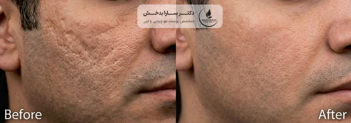قبل و بعد لیزر CO2 فرکشنال