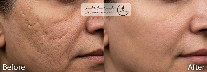 قبل و بعد لیزر CO2 فرکشنال