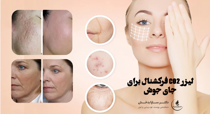 لیزر CO2 فرکشنال برای جای جوش