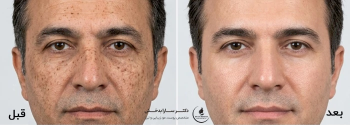 لیزر CO2 فرکشنال برای لک صورت