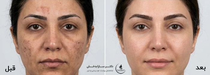 لیزر CO2 فرکشنال برای لک صورت