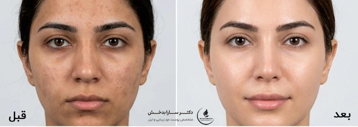 لیزر CO2 فرکشنال برای لک صورت