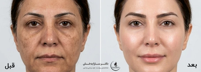 لیزر CO2 فرکشنال برای لک صورت