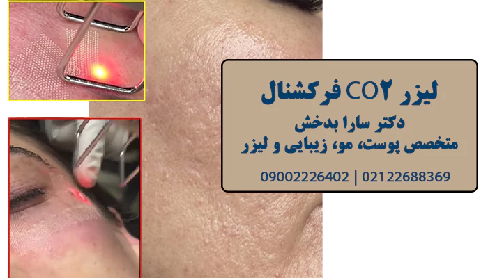 لیزر Co2 فرکشنال